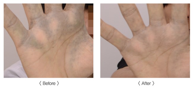 PICOS 皮秒激光去斑 before and after - 手