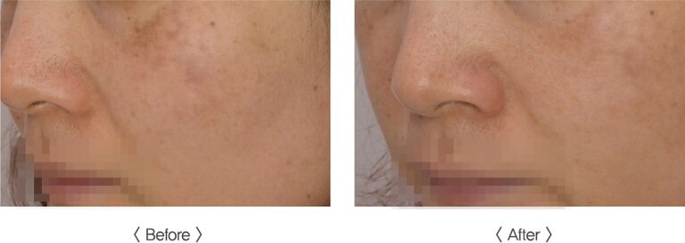 PICOS 皮秒激光去斑 before and after - 伊藤斑