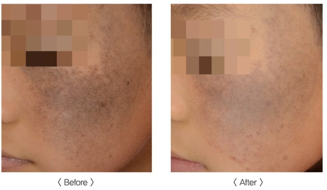 PICOS 皮秒激光去斑 before and after - 太田斑