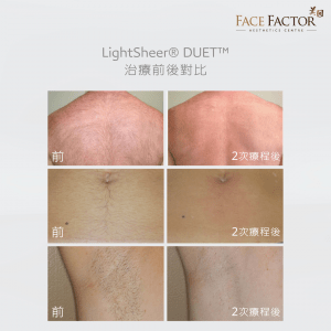 LIGHT SHEER Before & After